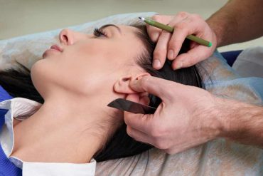 Acupuncture for Ageless Skin