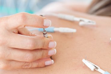 Unique Benefits of Acupuncture for Women