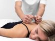 erks Of Taking Therapy Of Acupuncture Neck And Back Pain