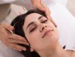 Relaxed Young Woman Receiving Acupuncture Treatment In Beauty Spa