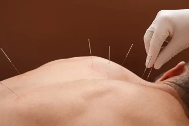 Arizona Workers’ Compensation Cover Acupuncture