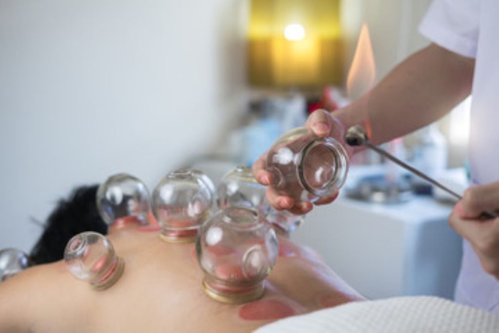 Cupping Therapy