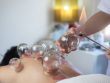 Cupping Therapy