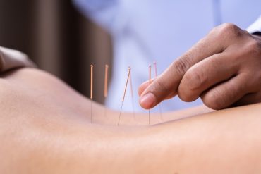 Five Things to Know About Dry Needling Tucson?