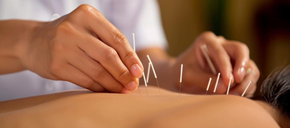 acupuncture