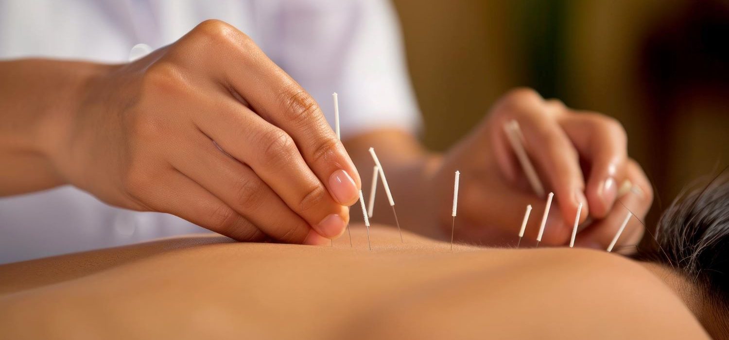 
Acupuncture Helps relief  your Stress 