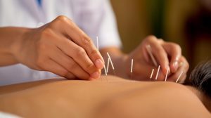 acupuncture