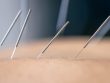 dry-needling