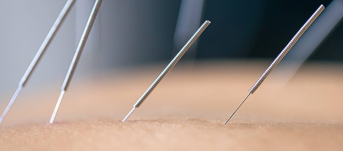 dry-needling