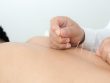 motor point acupuncture