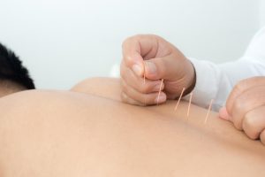 motor point acupuncture