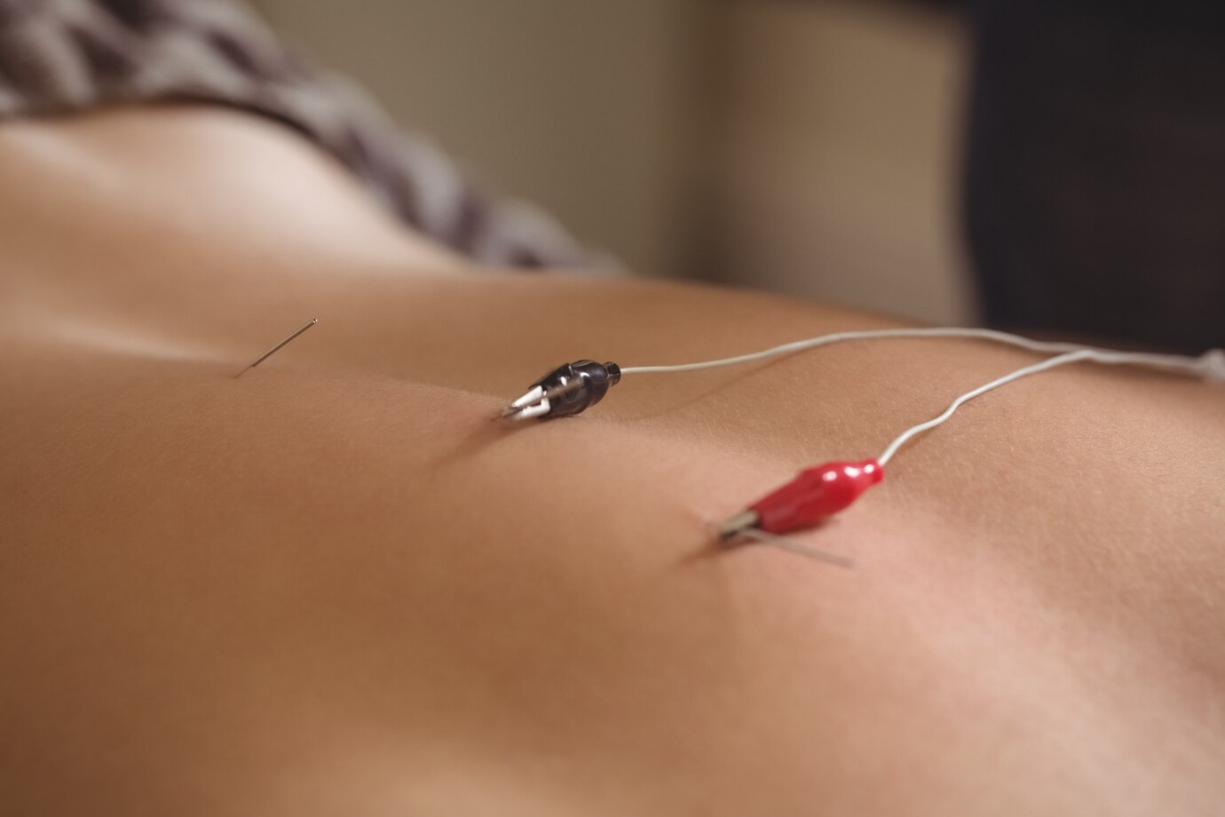 Tucson acupuncture