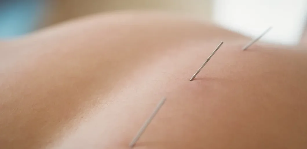 Acupuncture-Tucson