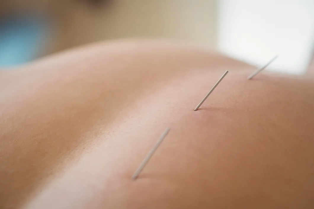 Acupuncture-Tucson