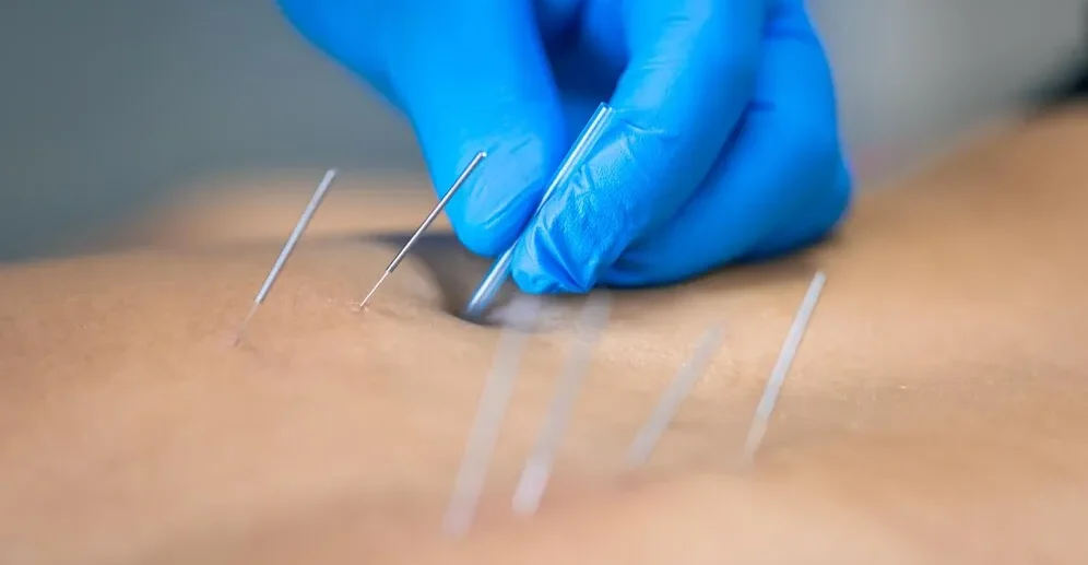 close-up-needle-hands-physiotherapist
