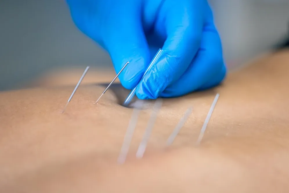 close-up-needle-hands-physiotherapist
