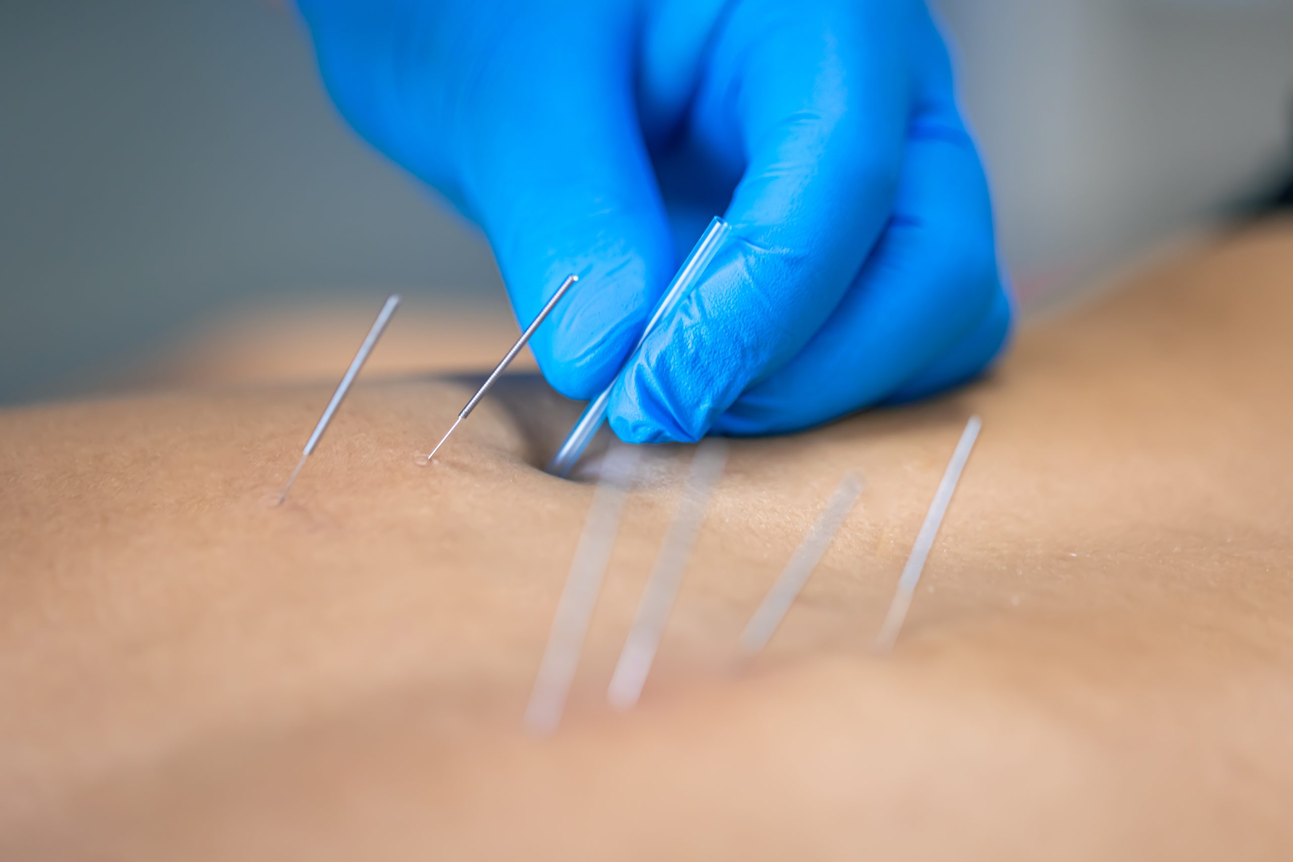 orthopedic acupuncture