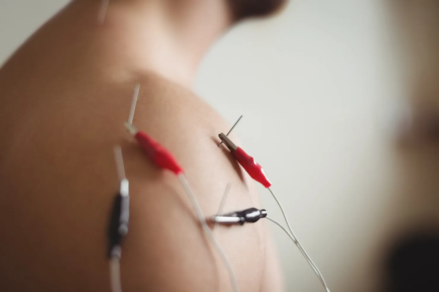 accupuncture