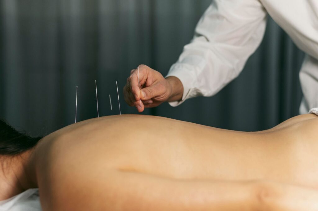 dry needleing
