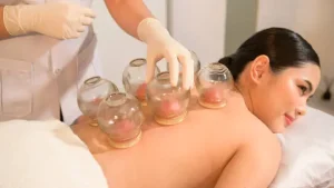 cupping therapy