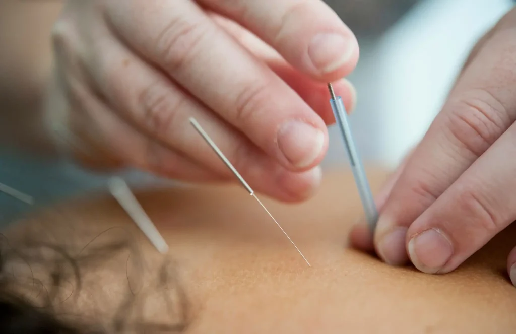 dry needling