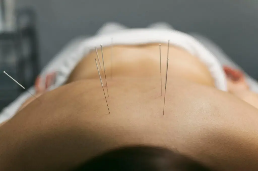 dry needling